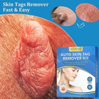 Assortment of rubber rings for different skin tag sizes, included in the remover kit.