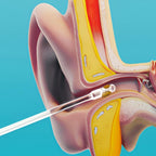 Hand demonstrating safe ear wax removal with a reusable ear cleaning tool.