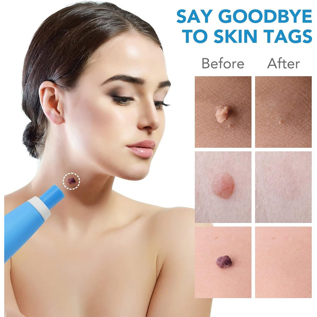 The Arrive Kit skin tag remover pen shown with its various accessories for effective treatment.