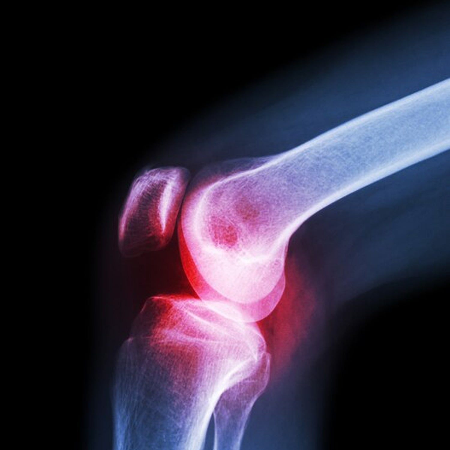Ergonomic XL Knee Cap for Support, enhancing comfort and stability.