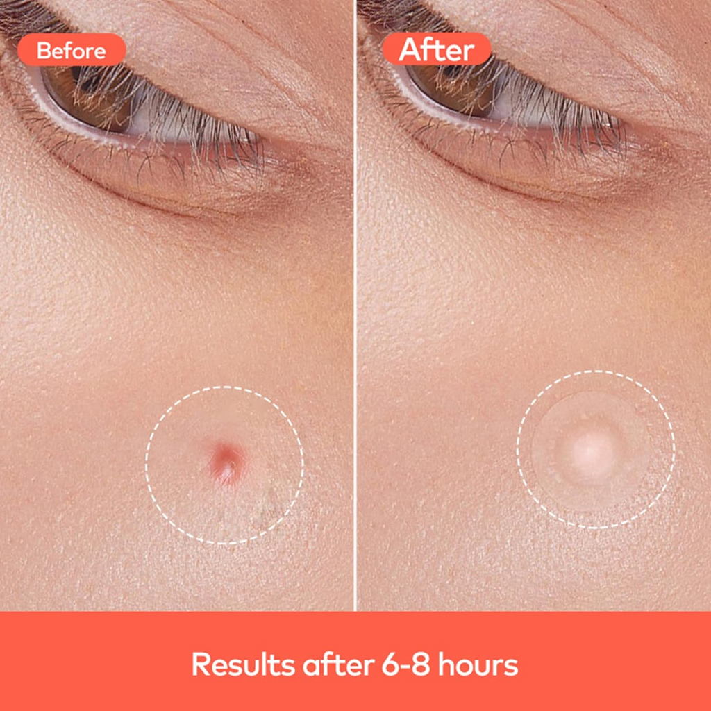 A complete set of GlowForm acne patches, showcasing multiple sizes for different blemishes.
