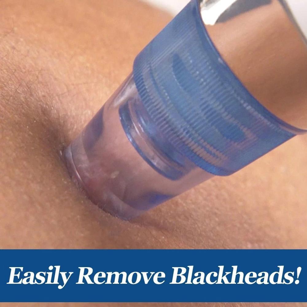 User demonstrating the pore cleaner tool for effective blackhead and acne extraction.